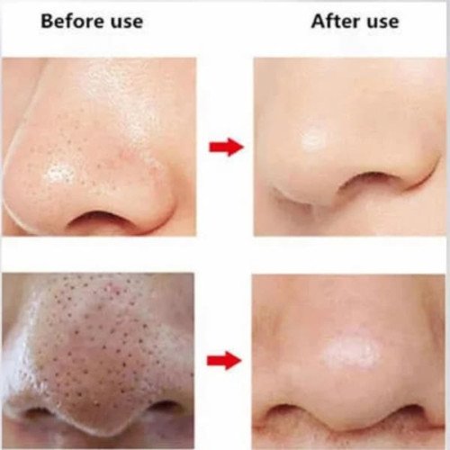 Buy Rechargeable Blackhead Remover Vacuum Cleaner
