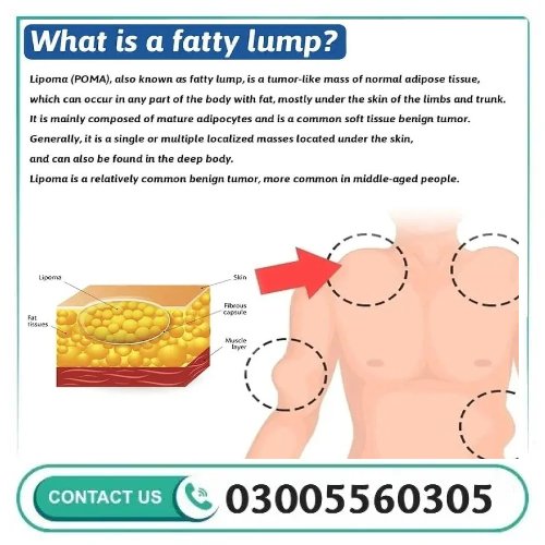South Moon Lipoma Removal Cream Price In Pakistan